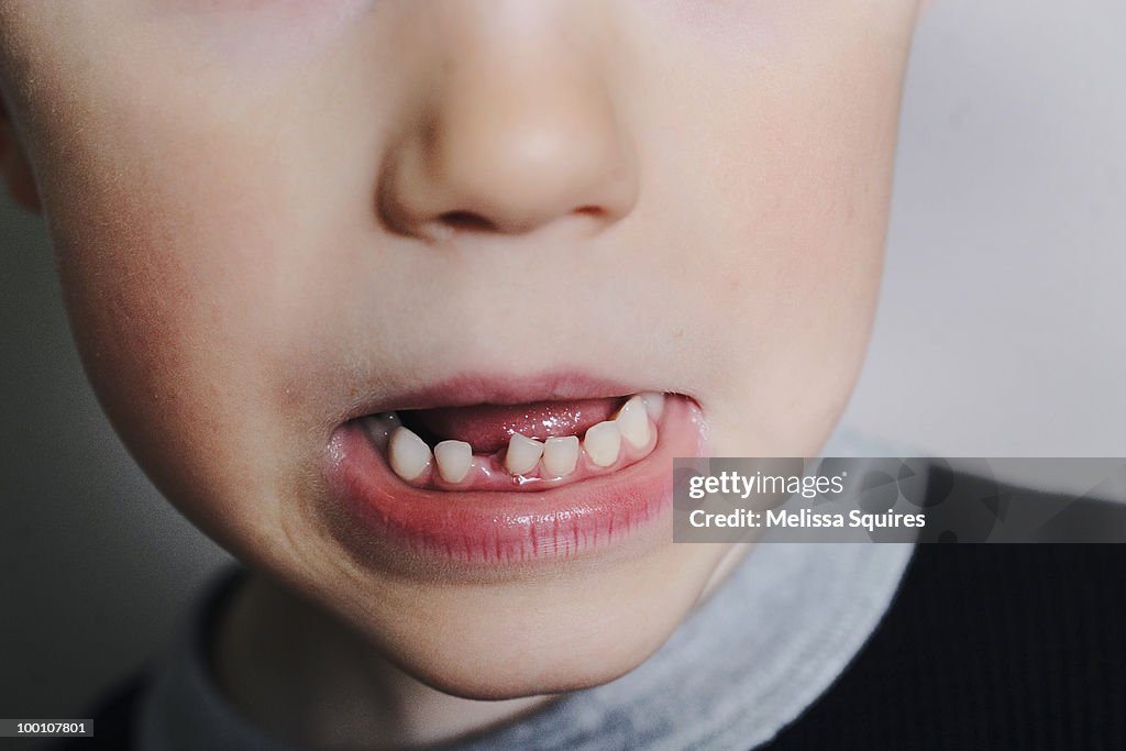 Loose tooth