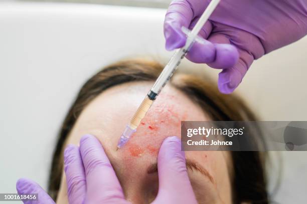 Infusing Plasma Plasma Infusion Photos and Premium High Res Pictures - Getty Images