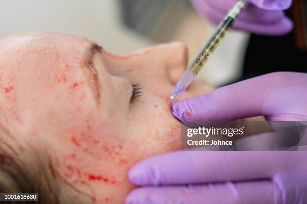 Infusing Plasma Plasma Infusion Photos and Premium High Res Pictures - Getty Images