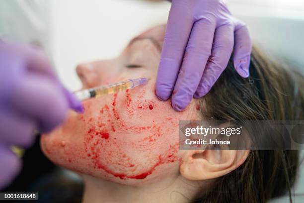 revolutionäre behandlung der verjüngung mit blutplasma - needling stock-fotos und bilder