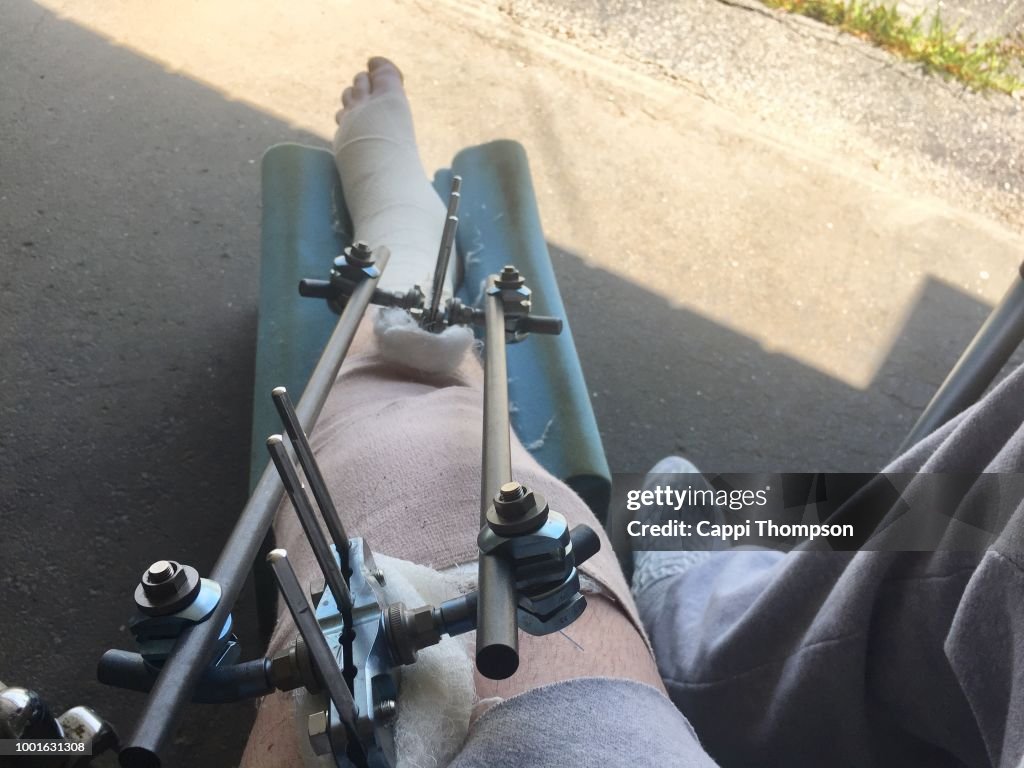 Tibia Shatter External Fixation Repairing Shattered Tibia Bone In Left Leg High-Res ...