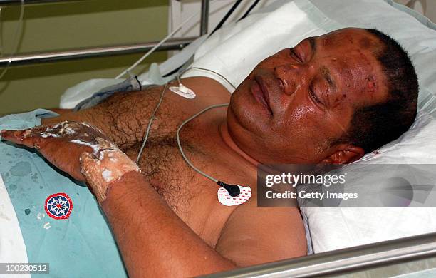 Survivor of the aircrash lays in a bed at a hospital on May 22, 2010 in Mangalore. An Air India Express Boeing 737-800 series aircraft overshot the...