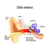 Swimmer's ear. Otitis externa