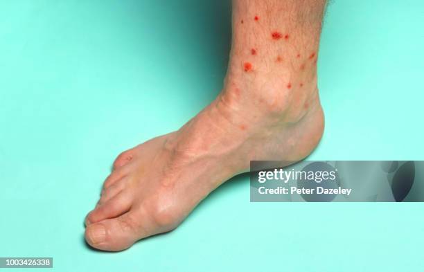 foot with summer insect bites - acaro del terreno foto e immagini stock