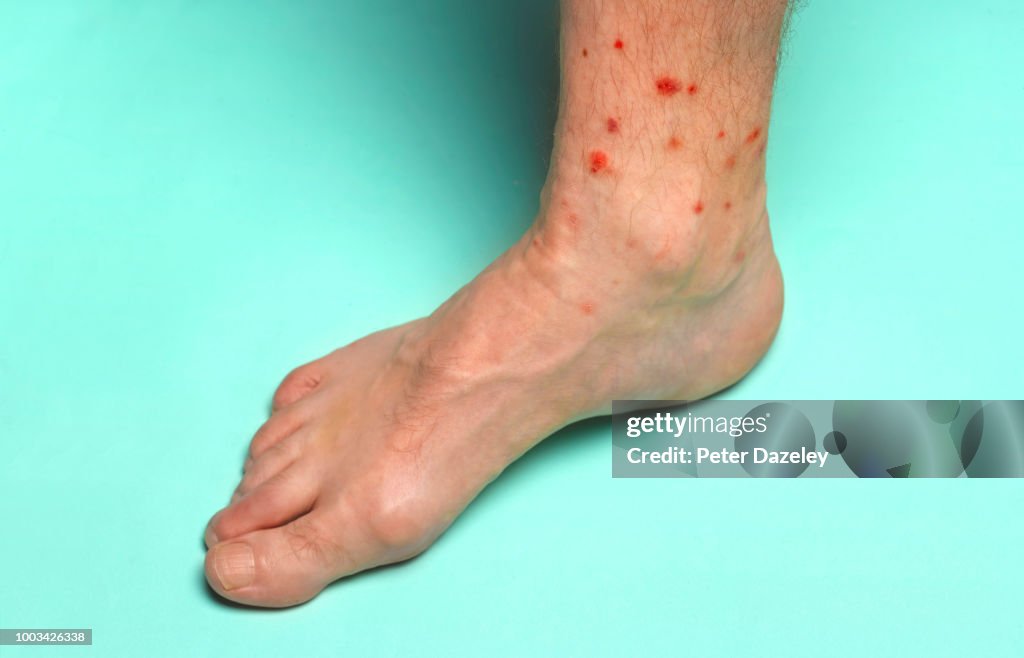 Foot with summer insect bites