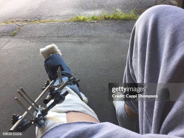 broken leg with external fixation and bent knee - surgical footwear stock pictures, royalty-free photos & images