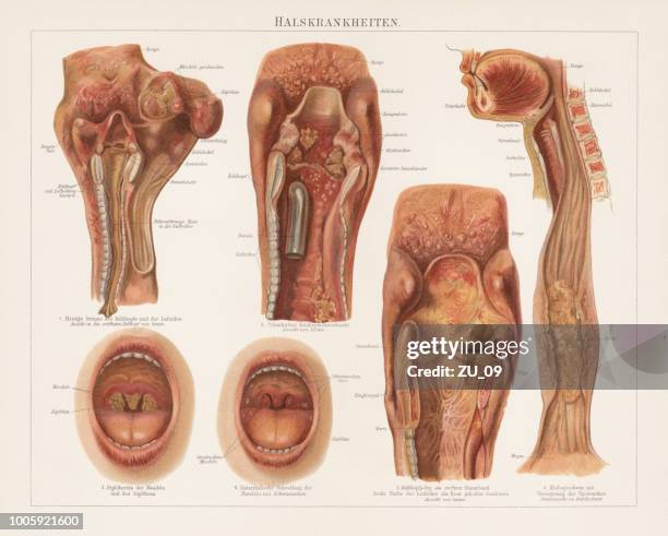 ilustraciones, imágenes clip art, dibujos animados e iconos de stock de enfermedades de la garganta, chromolitograph, publicaron en 1897 - aftas