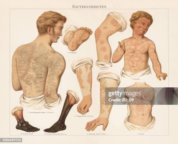 skin diseases, chromolitograph, published in 1897 - psoriasis skin stock illustrations