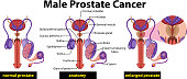 Male prostate cancer diagram