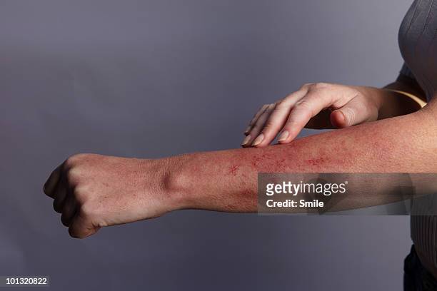 hand feeling rash on arm - quemado por el sol fotografías e imágenes de stock