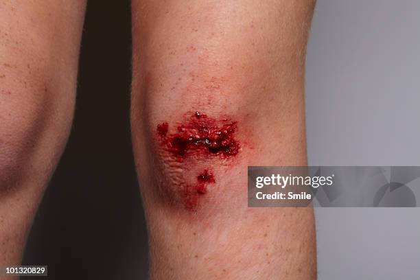 grazed knee, close-up - wunde stock-fotos und bilder