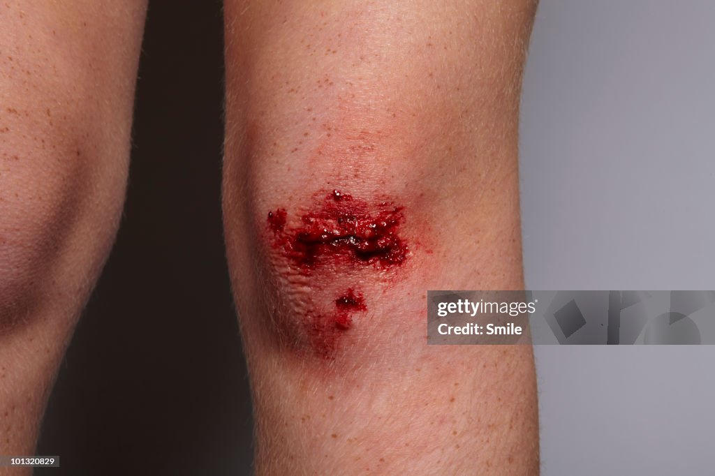 Grazed knee, close-up