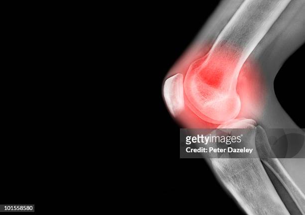 x ray of knee leg in pain - arrodillarse fotografías e imágenes de stock