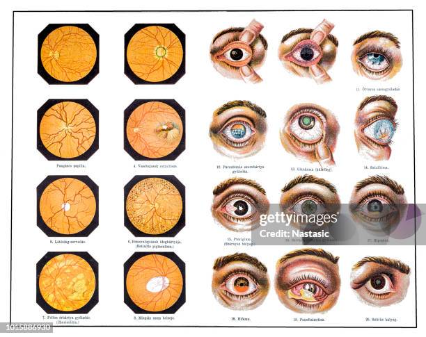 eye problems - eye cross section stock illustrations