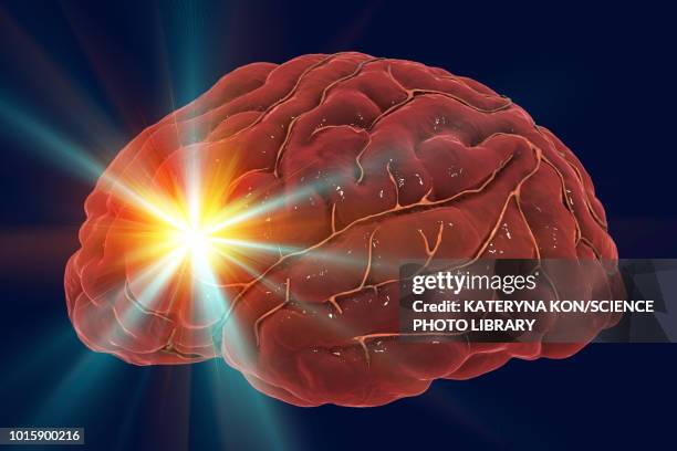 stroke, illustration - infarction stock illustrations