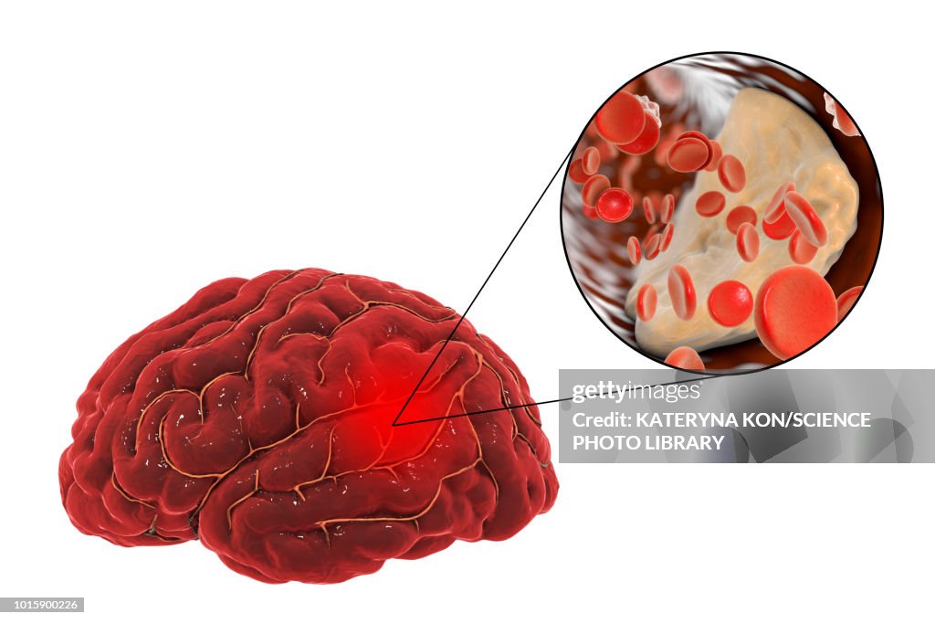 Stroke Illustration High-Res Vector Graphic - Getty Images