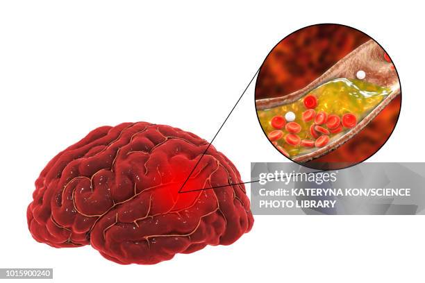 stockillustraties, clipart, cartoons en iconen met stroke due to atherosclerosis, conceptual illustration - atheromatose