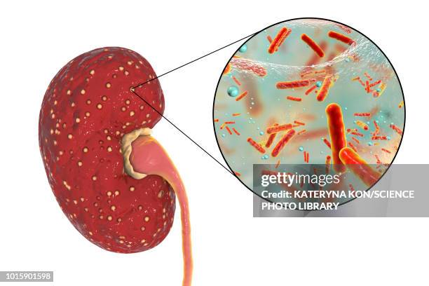 acute pyelonephritis, illustration - enterococcus stock illustrations