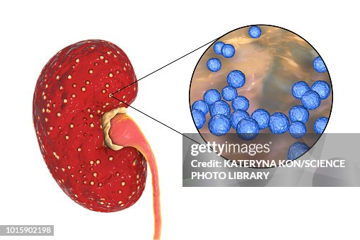 Acute pyelonephritis caused by Enterococcus, illustration Acute pyelonephritis caused by Enterococcus, illustration