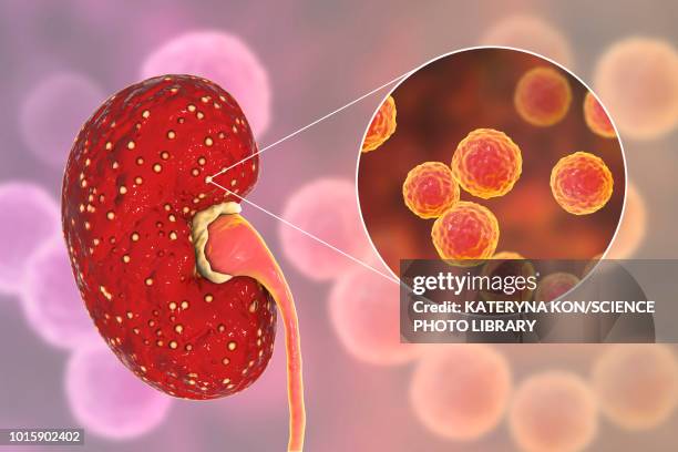 acute pyelonephritis caused by enterococcus, illustration - enterococcus stock illustrations