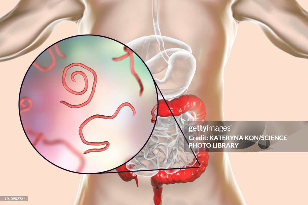Long Thread Worms Threadworm Infection Illustration High-Res Vector Graphic - Getty Images