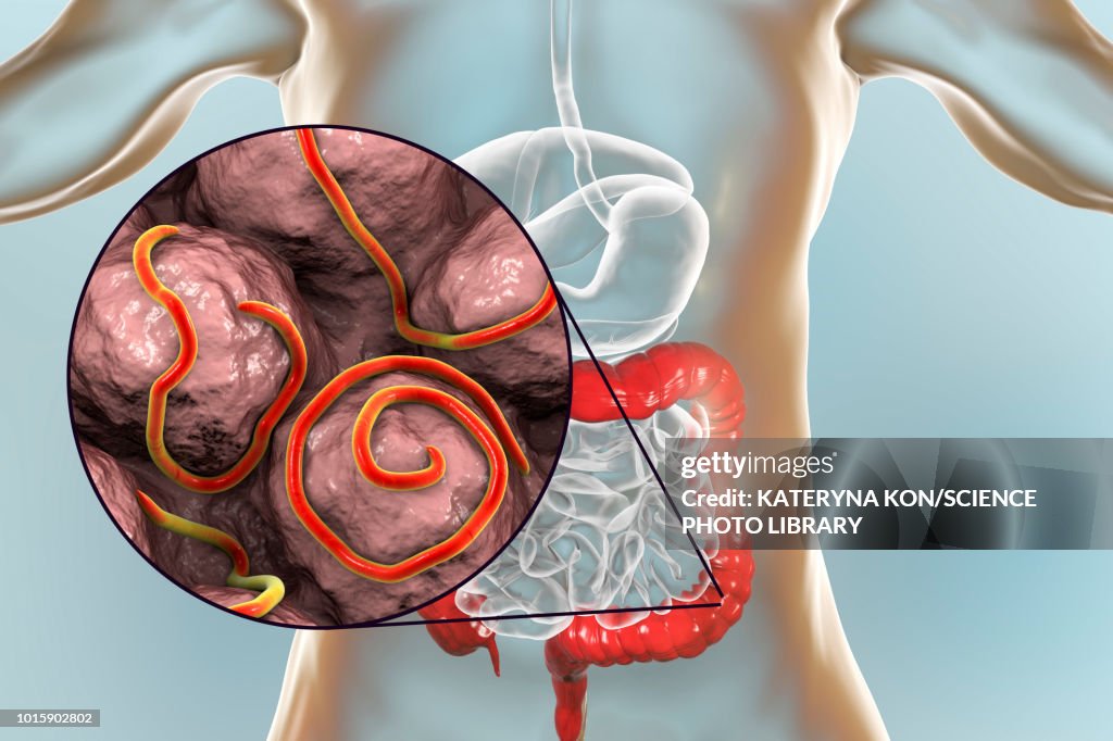 Long Thread Worms Threadworm Infection Illustration High-Res Vector Graphic - Getty Images