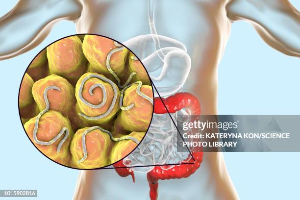 Threadworm Pil Threadworm Infection Illustration High-Res Vector Graphic - Getty Images