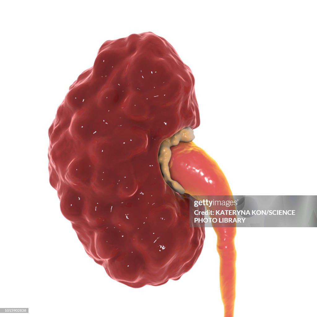 Chronic pyelonephritis, illustration