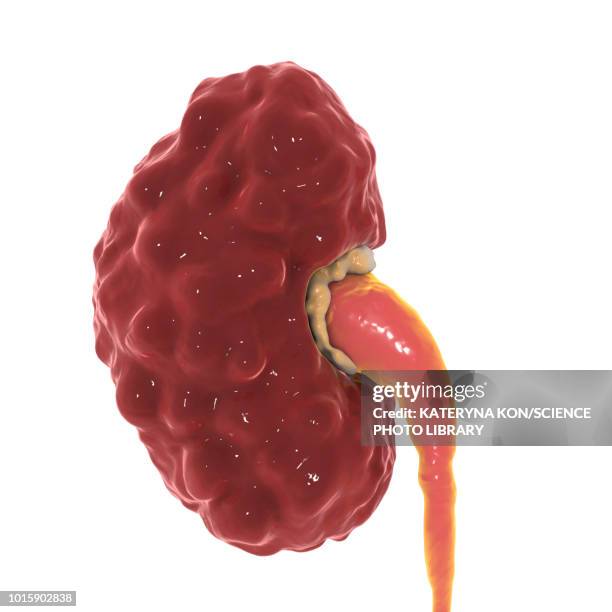 chronic pyelonephritis, illustration - scar stock illustrations