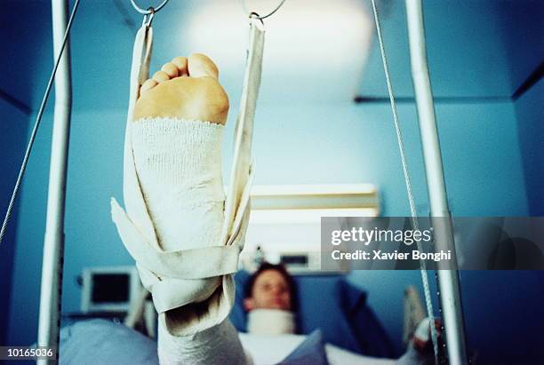 man in body cast with foot in traction - man in hospital stockfoto's en -beelden