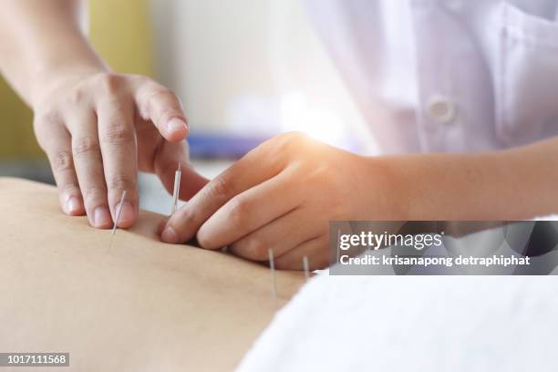 traditional chinese medicine treatment - acupuncture,acupuncture - acupuncture stockfoto's en -beelden