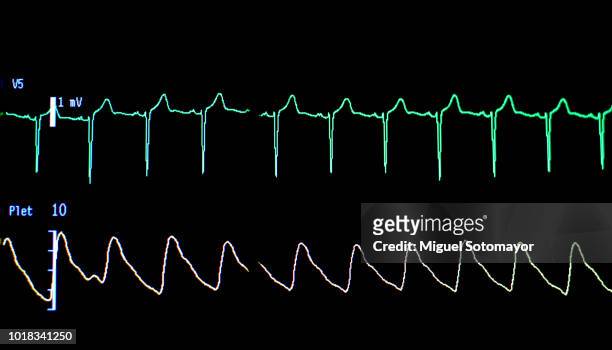 electrocardiogram.the traces of lives - rhythm stock-fotos und bilder