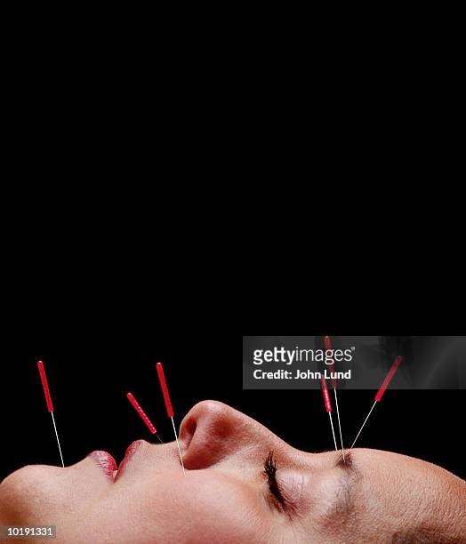 woman undergoing acupuncture treatment on face, close-up - agopuntura foto e immagini stock