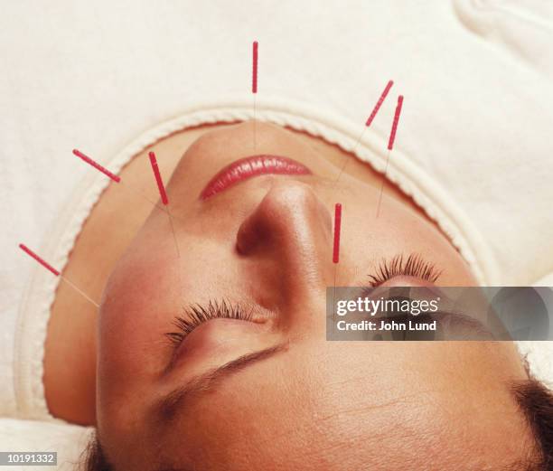 woman undergoing acupuncture treatment, needles in face - acupuncture stockfoto's en -beelden