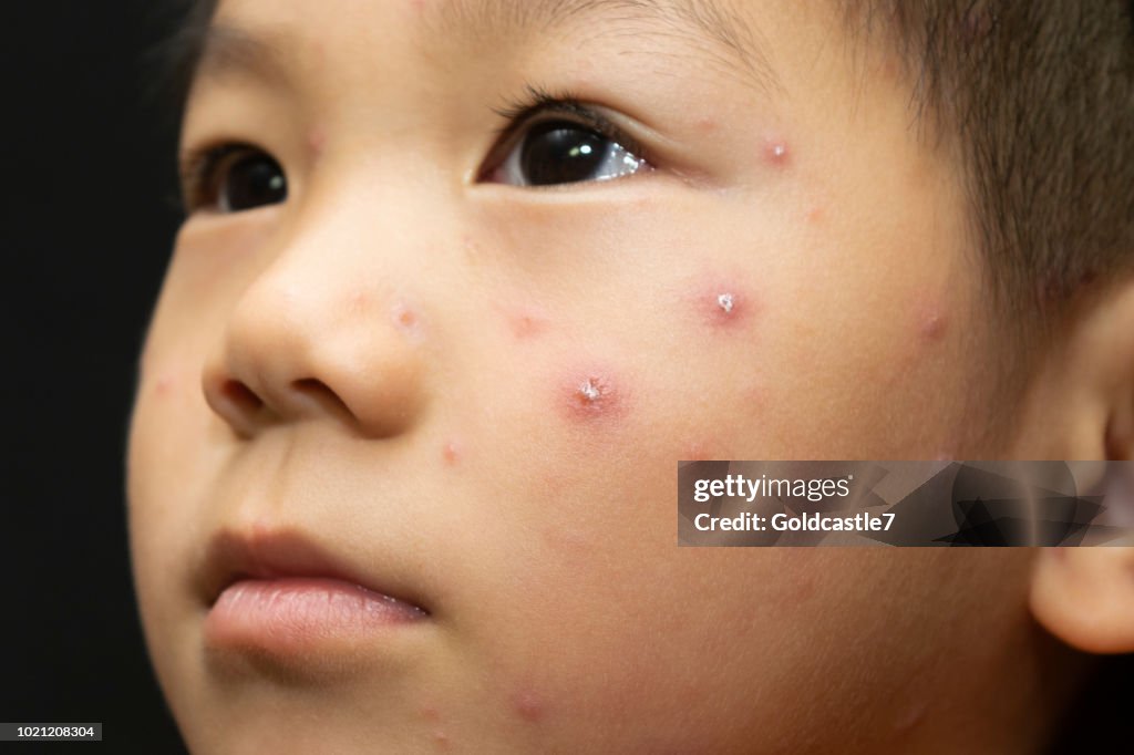 A male child with chickenpox
