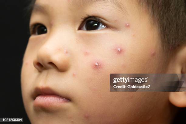 a male child with chickenpox - chickenpox stock pictures, royalty-free photos & images