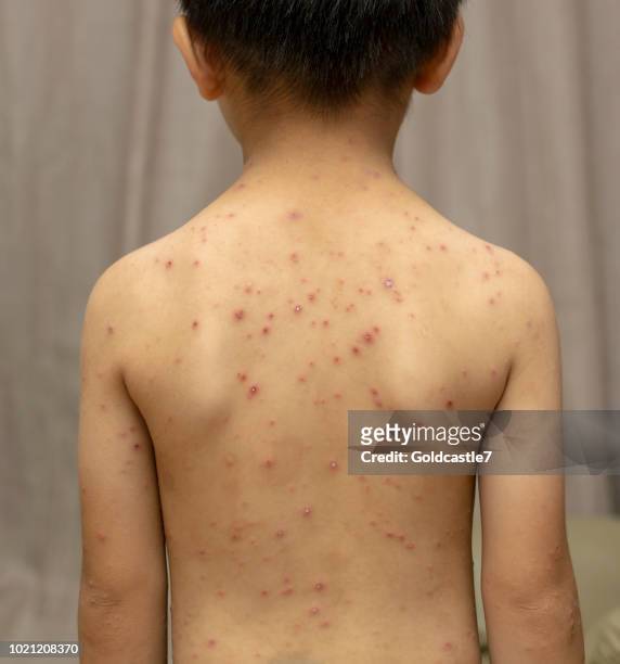 ein männliches kind mit windpocken - rückansicht - chickenpox stock-fotos und bilder