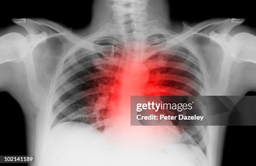 X-ray of lung with heart attack X-ray of lung with heart attack