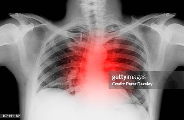 x-ray of lung with heart attack - heart chest xray stock pictures, royalty-free photos & images