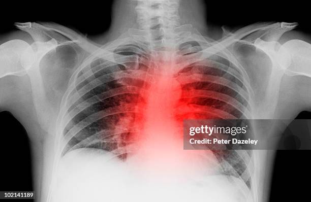 x-ray of lung with heart attack - condition stock pictures, royalty-free photos & images