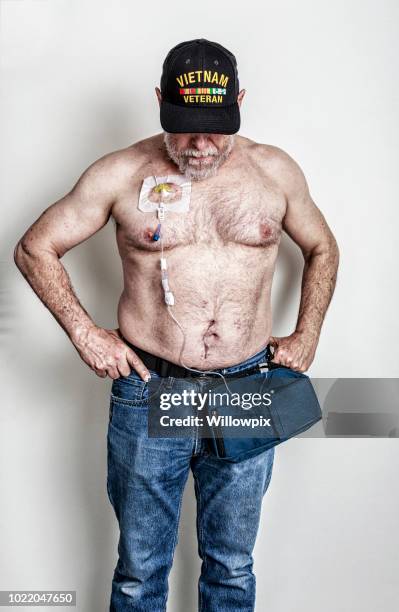 militärischen veteran krebs patienten chemotherapie iv pumpe an brust infusion port angeschlossen - port males chemo stock-fotos und bilder