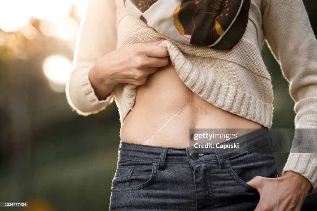 Girl showing her liver transplant scars