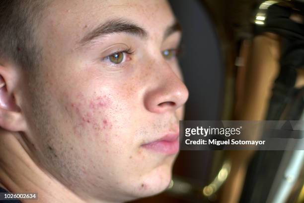teen with acne - eye problems stock pictures, royalty-free photos & images