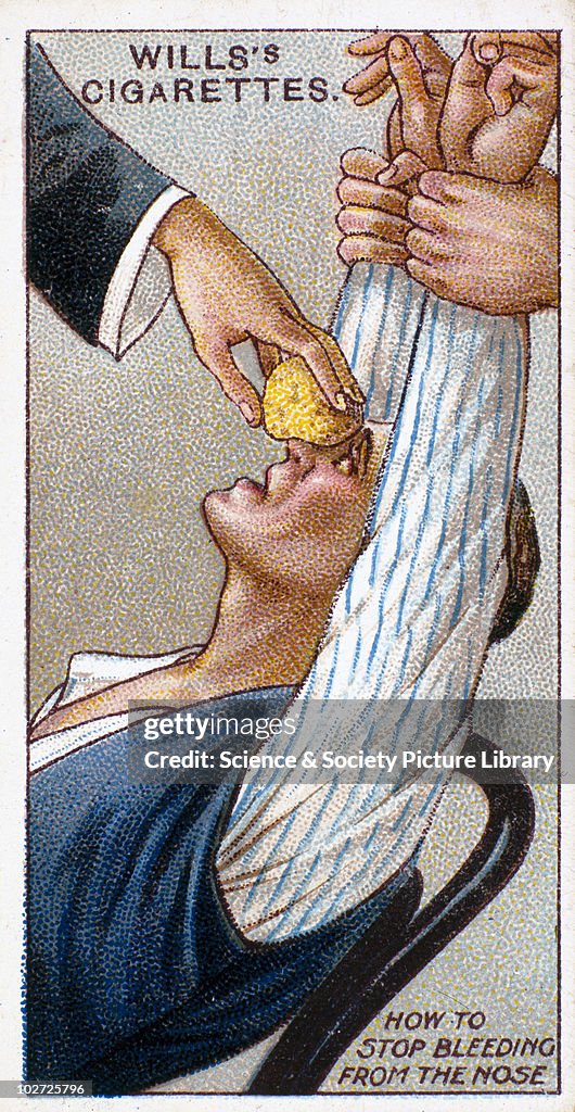 How to stop the nose from bleeding'. Wills' cigarette card, 1913.