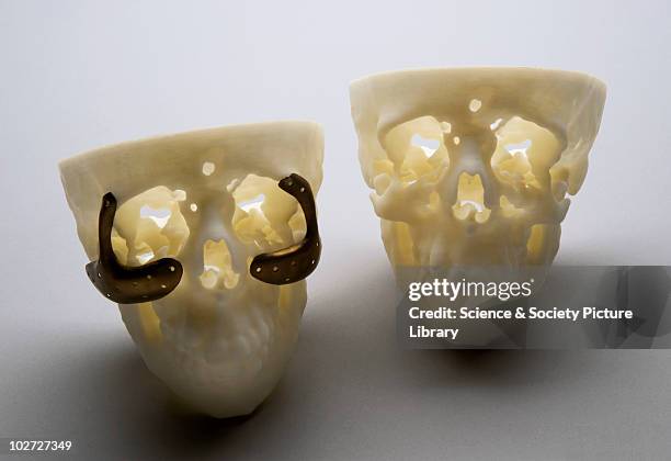 Model of a skull with treatment for the genetic disease Treacher Collins' syndrome, London, England, 1999. A 3-D model of a skull of a female patient...