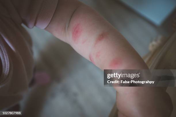 arm covered in a skin allergy,hives. - mosquito bite stock-fotos und bilder