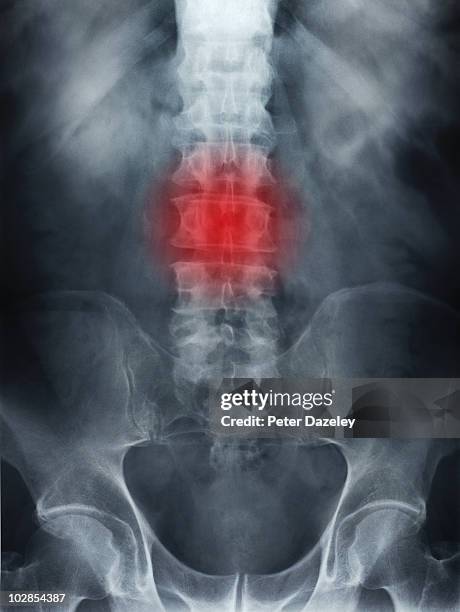 x-ray of spine showing back ache - hernia stockfoto's en -beelden