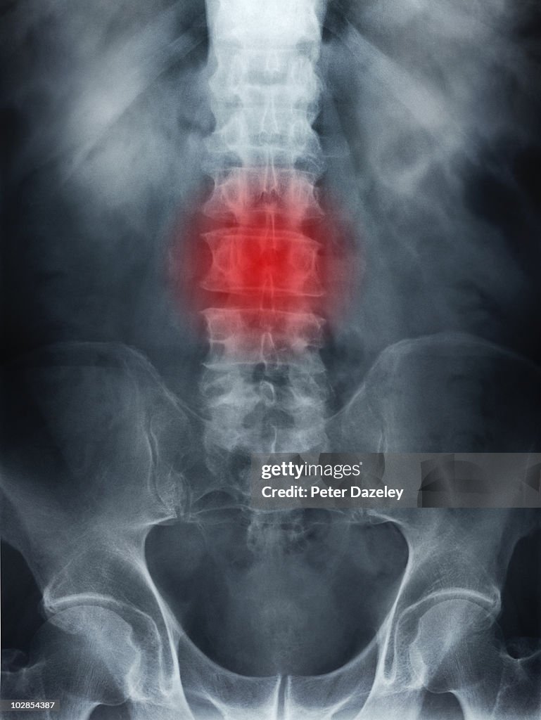 X-ray of spine showing back ache