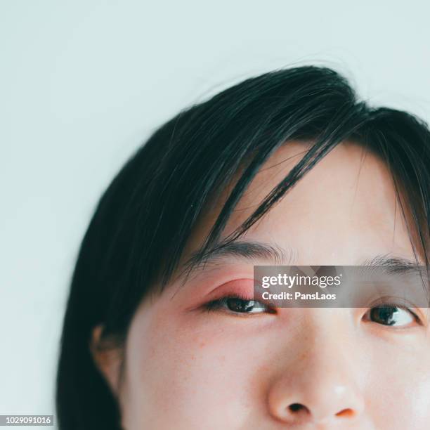 medical hordeolum ill eyes - stye stock pictures, royalty-free photos & images