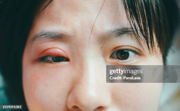 medical hordeolum ill eyes - hinchado-inflamación fotografías e imágenes de stock